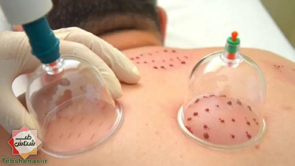 بهترین زمان حجامت. بایدها و نبایدهای حجامت در طب سنتی