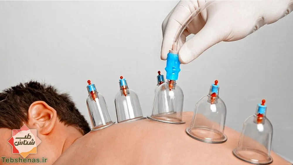 حجامت راهکار پاکسازی بدن