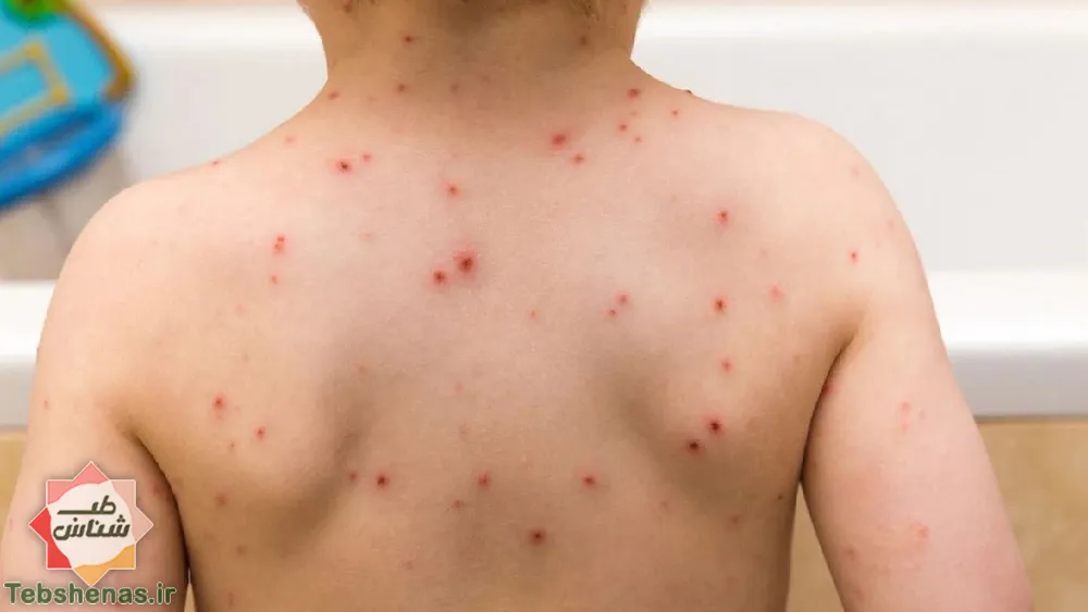 پیشگیری از آبله میمونی با طب سنتی