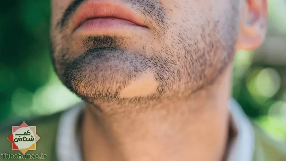 درمان ریزش مو سکه ای در طب سنتی|درمان ریزش مو سکه ای در طب سنتی + 10 دارو گیاهی فوق العاده برای درمان ریزش مو سکه ای|درمان ریزش مو سکه ای