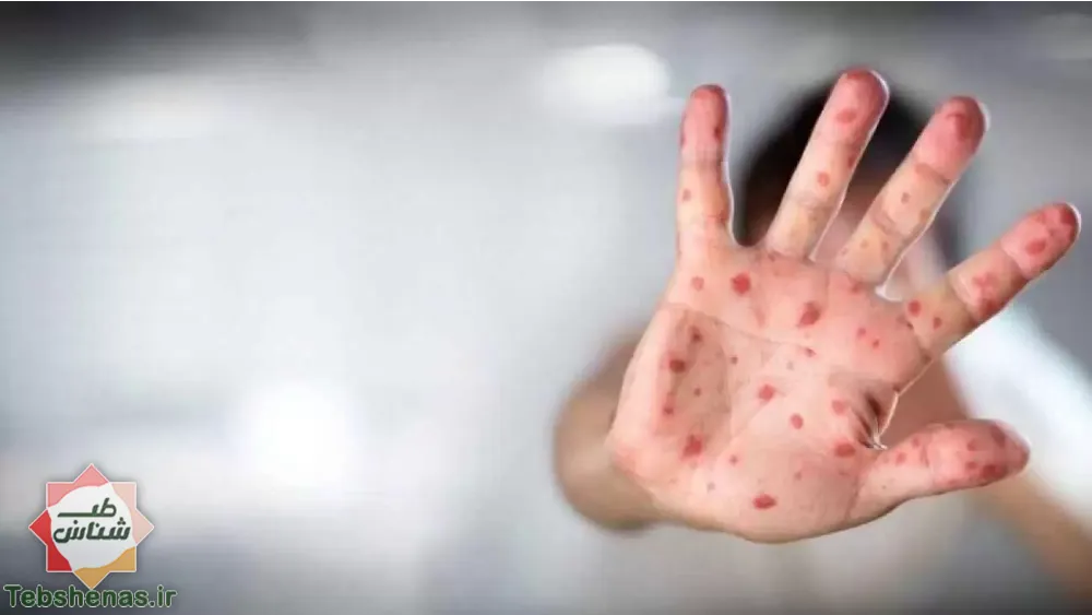 همه چیز در باره آبله میمونی+ علائم و راه های انتقال|همه آنچه باید در مورد آبله میمونی بدانیم|همه آنچه باید در مورد آبله میمونی بدانیم