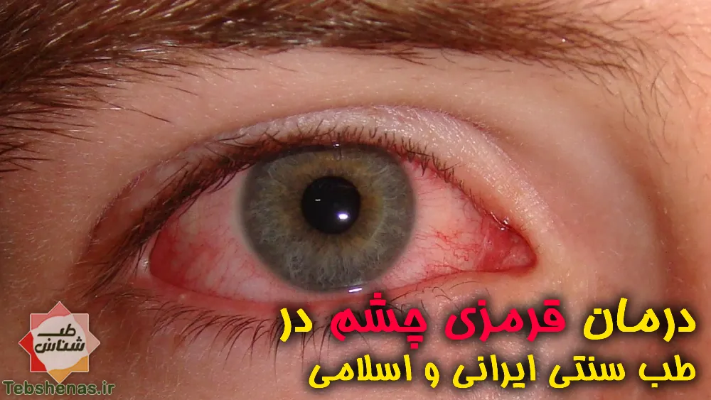 درمان فوری قرمزی چشم با طب سنتی ایرانی و اسلامی