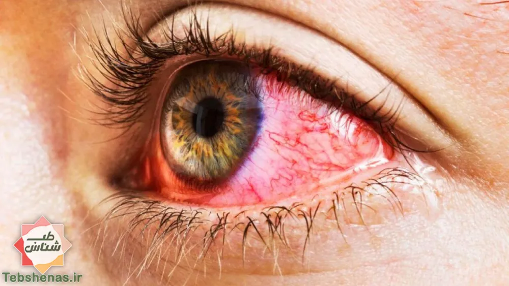 درمان فوری قرمزی چشم