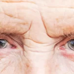 درمان ماکولا چشم با طب سنتی + 12 راه برای درمان خانگی ماکولا چشم
