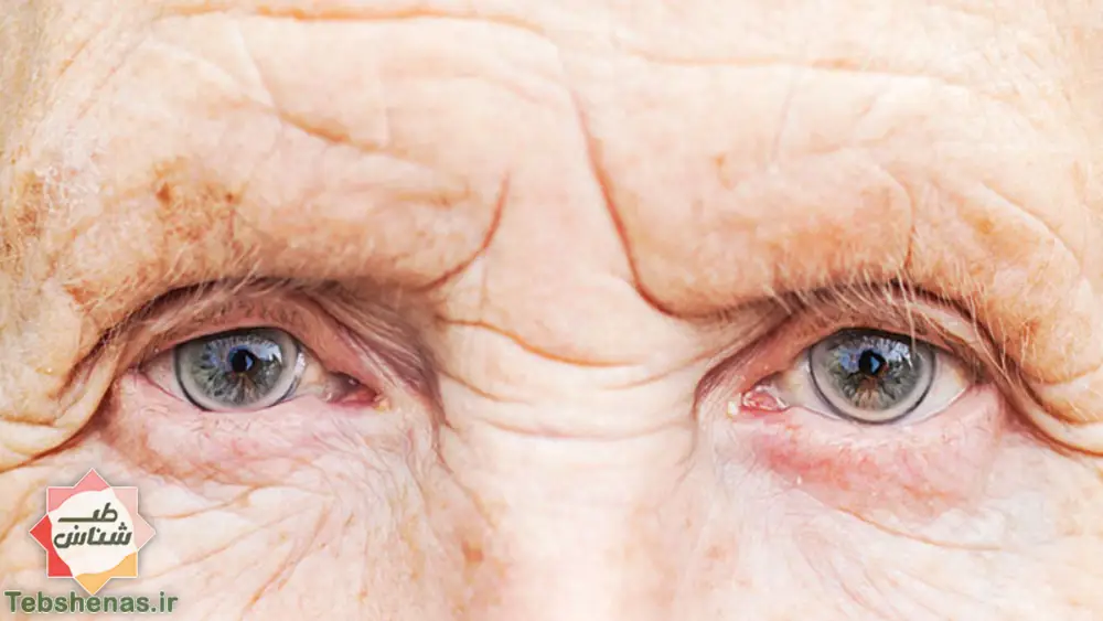 درمان ماکولا چشم با طب سنتی + 12 راه برای درمان خانگی ماکولا چشم