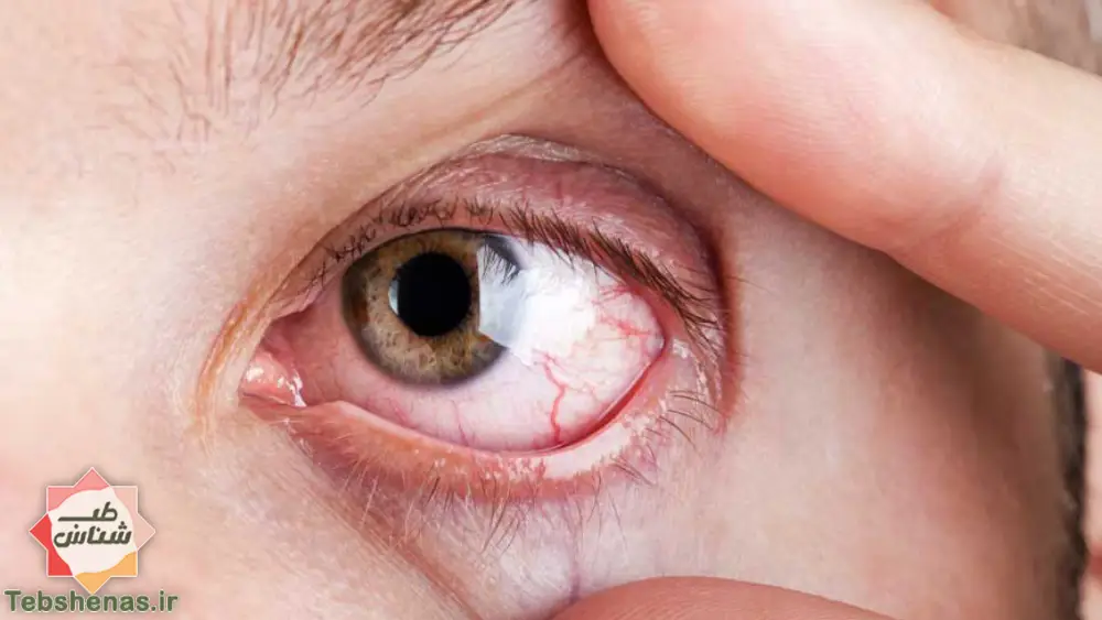 10 روش برای درمان خشکی چشم در طب سنتی