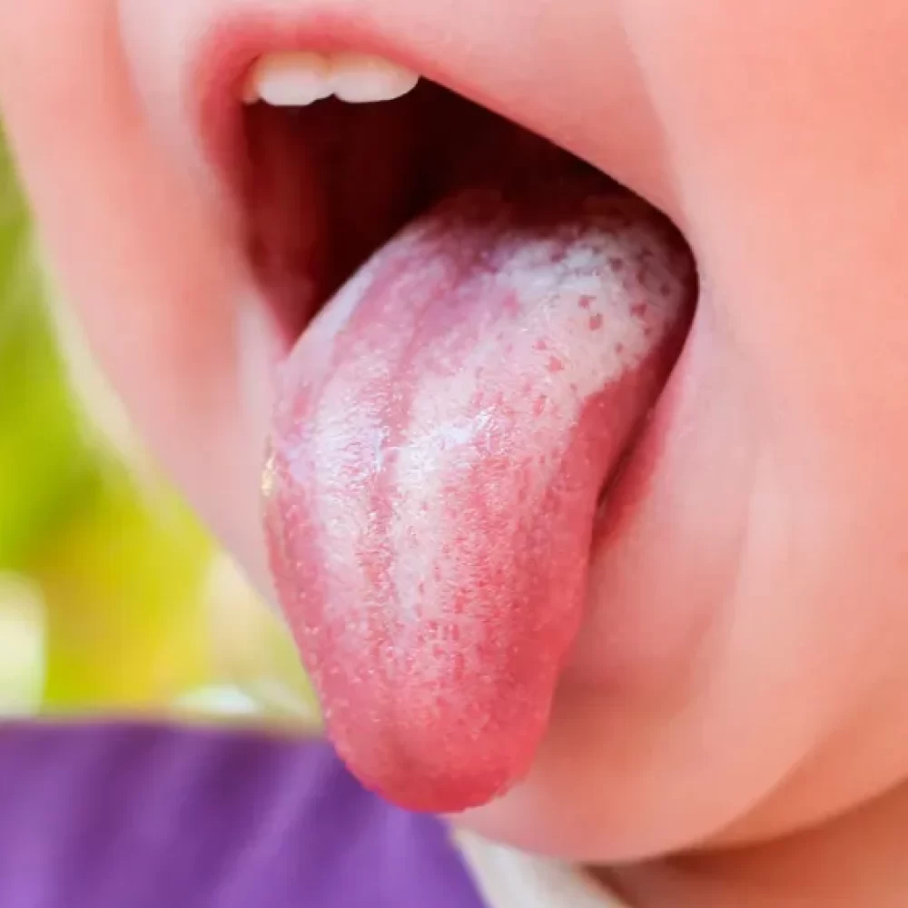 درمان برفک دهان نوزاد با تدابیر طب سنتی