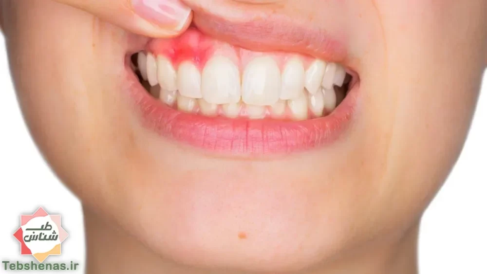 درمان خانگی آبسه دندان و درد دندان