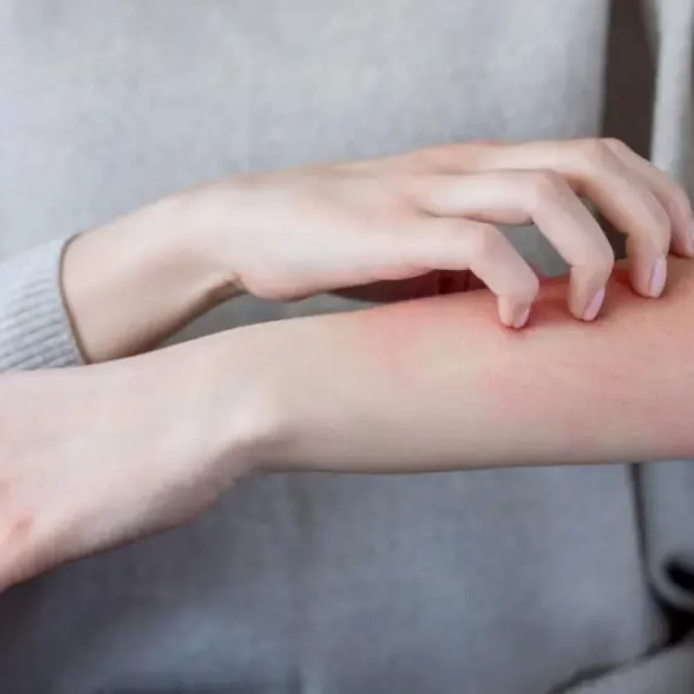 درمان فوری حساسیت پوستی در طب سنتی + 8 راهکار برای درمان خانگی حساسیت پوستی