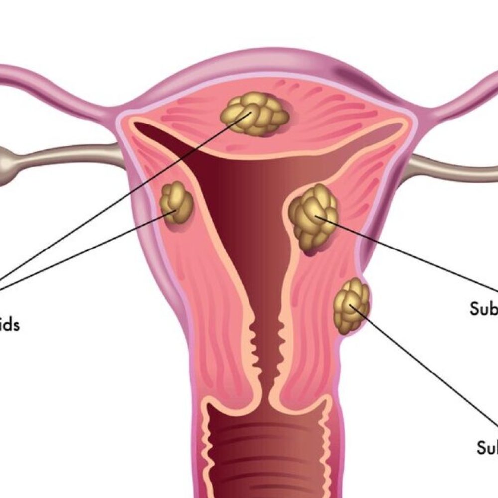 فیبروم رحمی- بین طب سنتی و مدرن